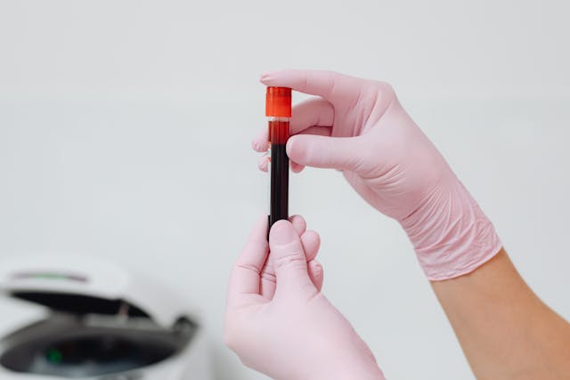 Test for Hepatitis | Hepatitis A, B, C | Singapore Diagnostics